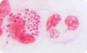 淋病（Neisseria gonorrhoeae）
